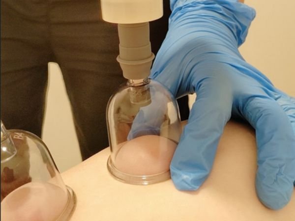 Cupping